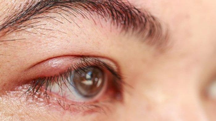 ketahui penyebab mata bengkak dan sembuhkan dengan 6 cara ini