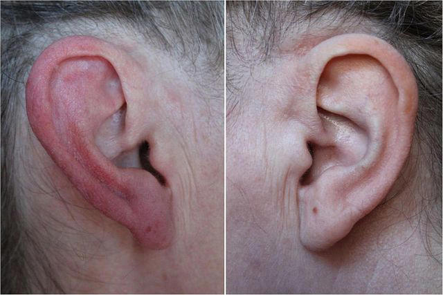 Why do my ears turn red and how do I fix it?