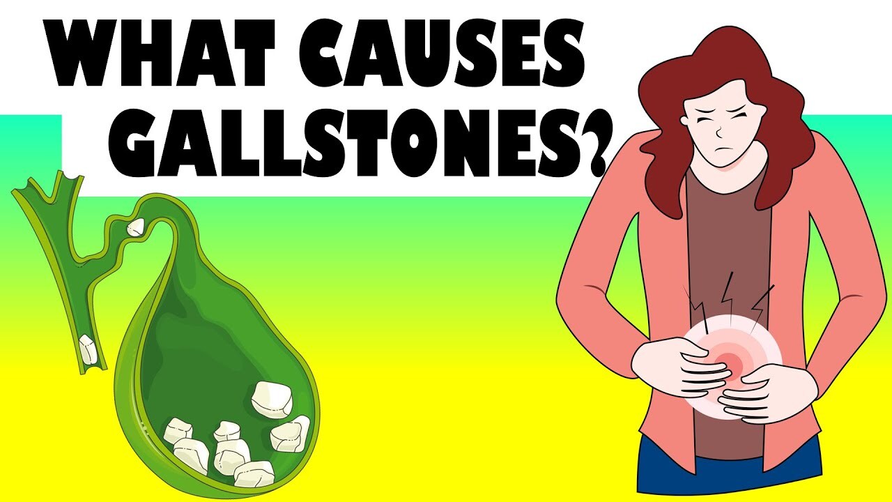 What Causes Gallstones Major Causes Of Gallstone Disease Gallstones   AA1jfADy.img