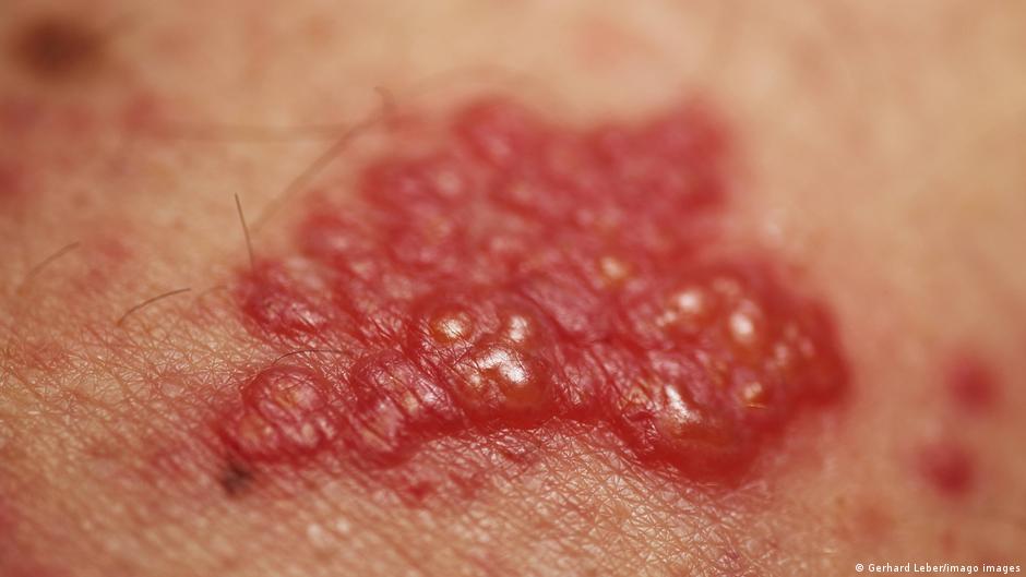 Do You Get Shingles If You Had Chickenpox?