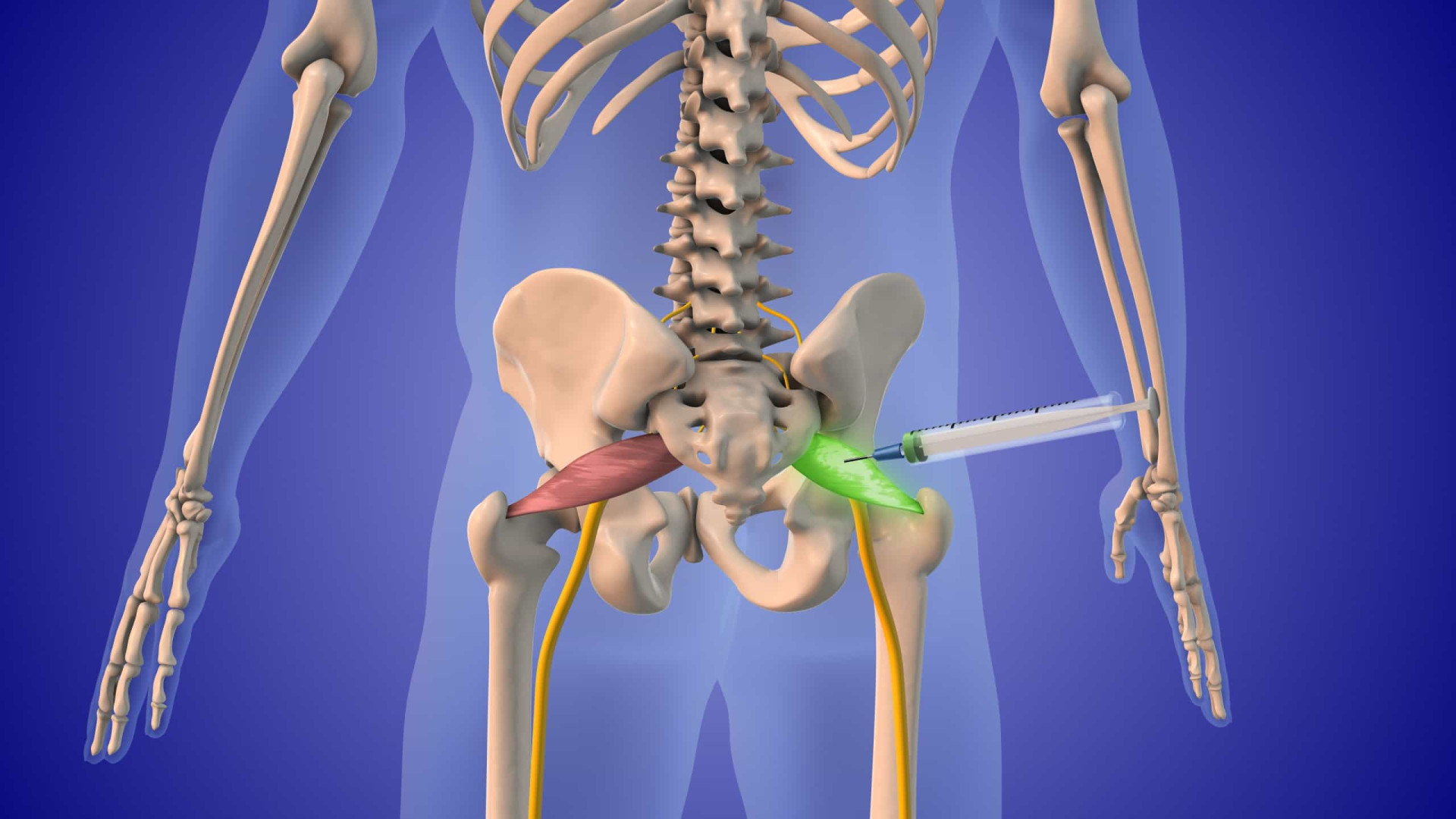 Sindrome del piriforme: come la sciatica, ma le cause sono ...