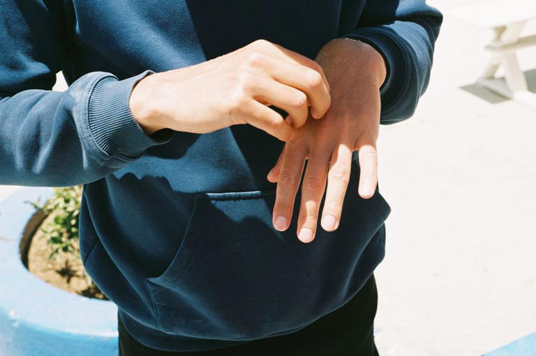 Health experts explain how to spot scabies symptoms and stop spread as