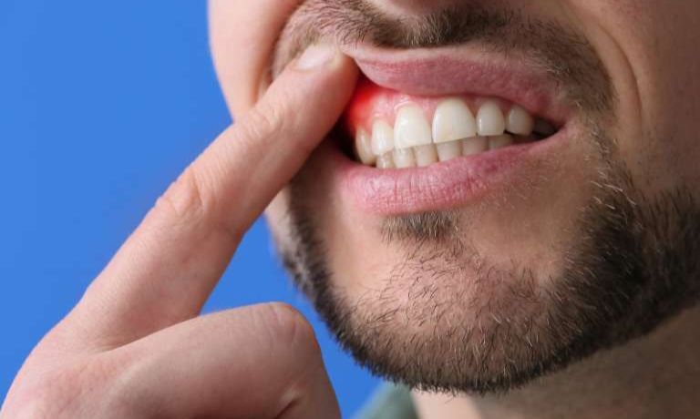 salud bucal: qué se debe tener en cuenta para el cuidado de las encías