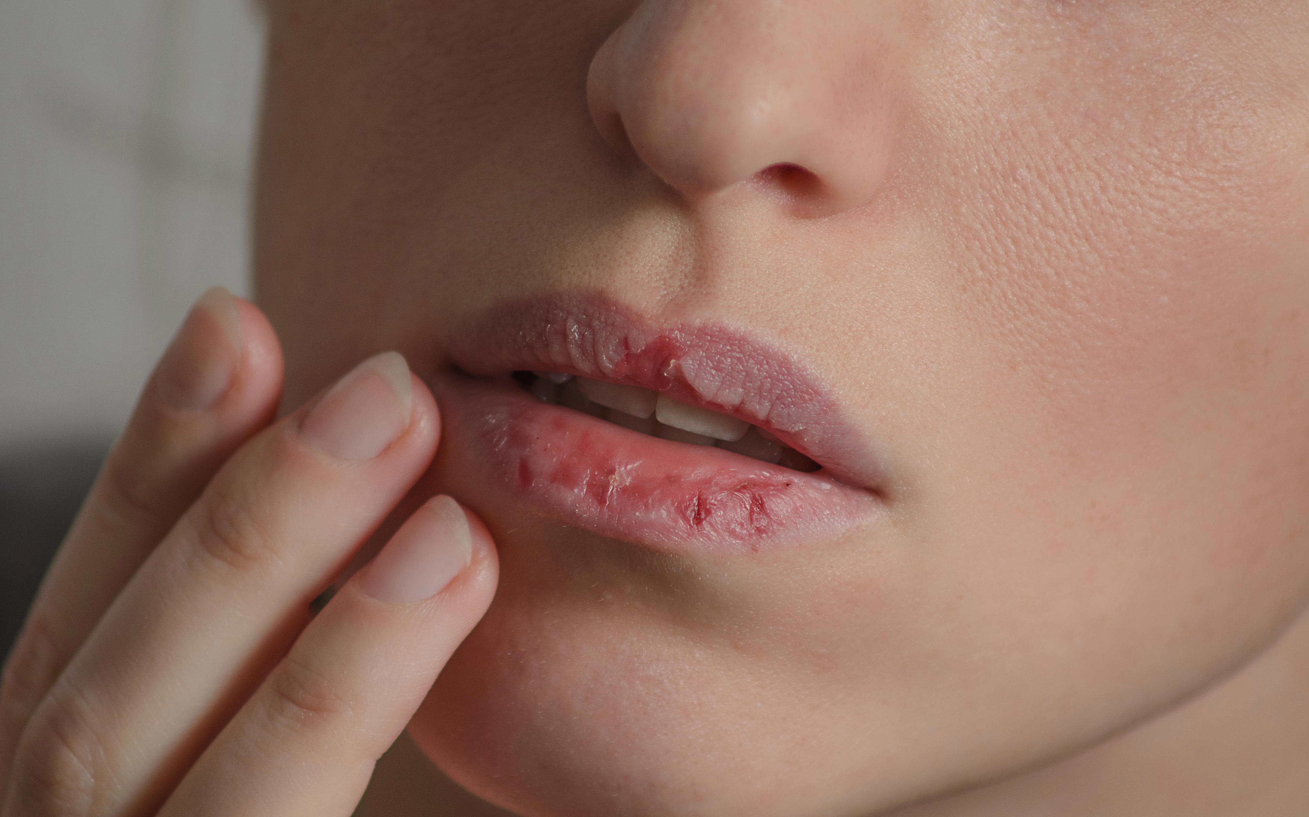 dealing with dry lips? there are many possible reasons.