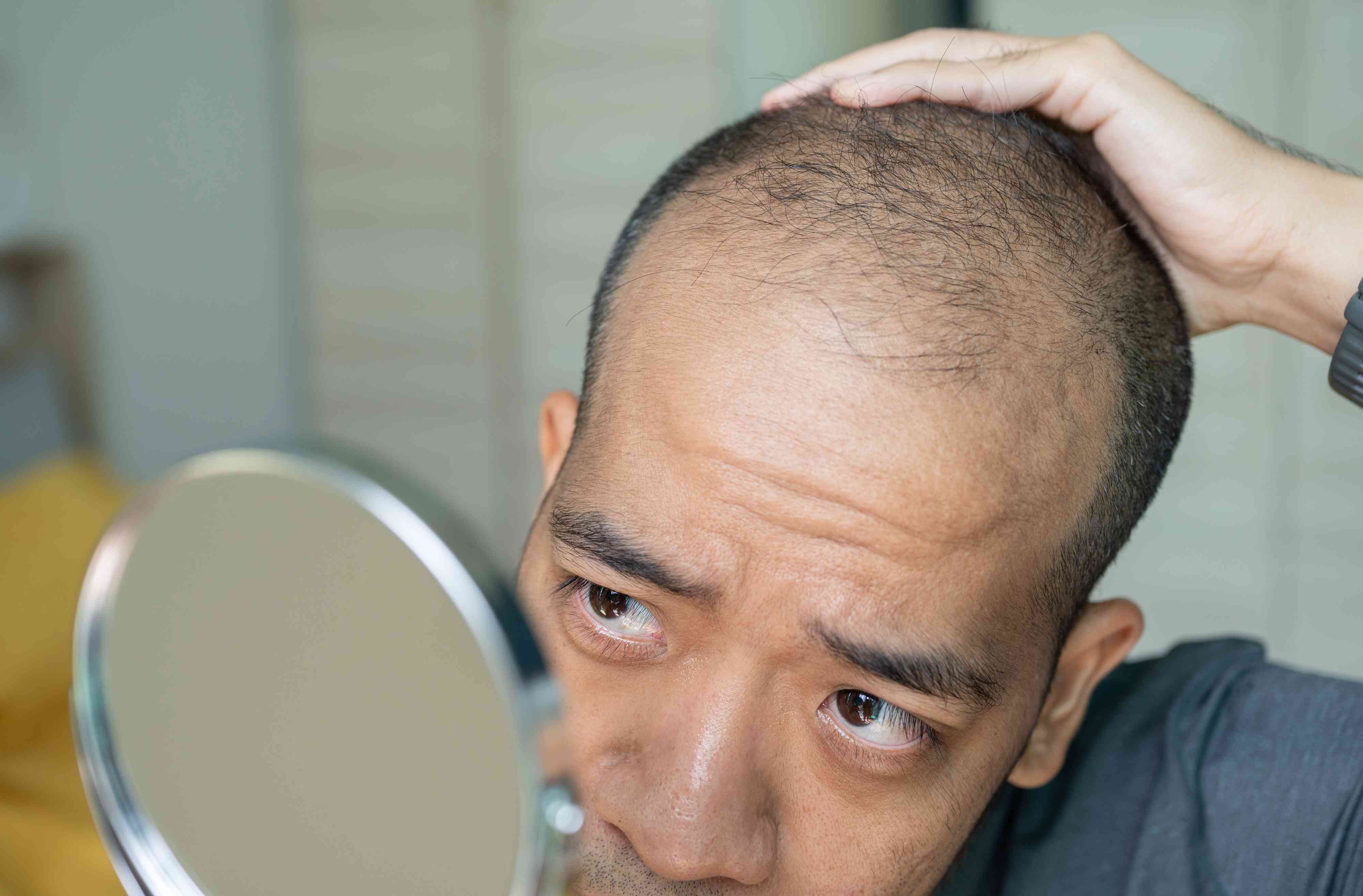 Which Vitamin Deficiency Causes Hair Loss?
