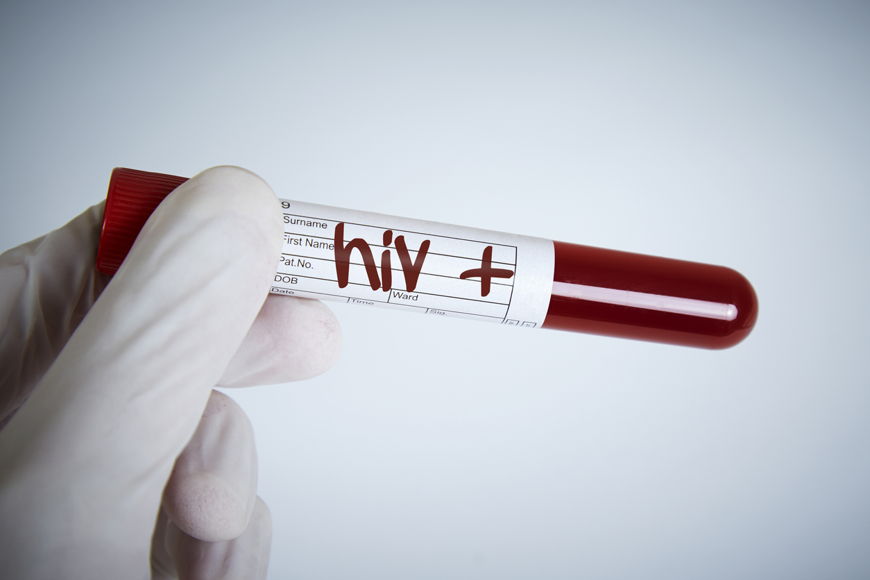 hiv: 6 sinais e sintomas precoces causados pela infecção