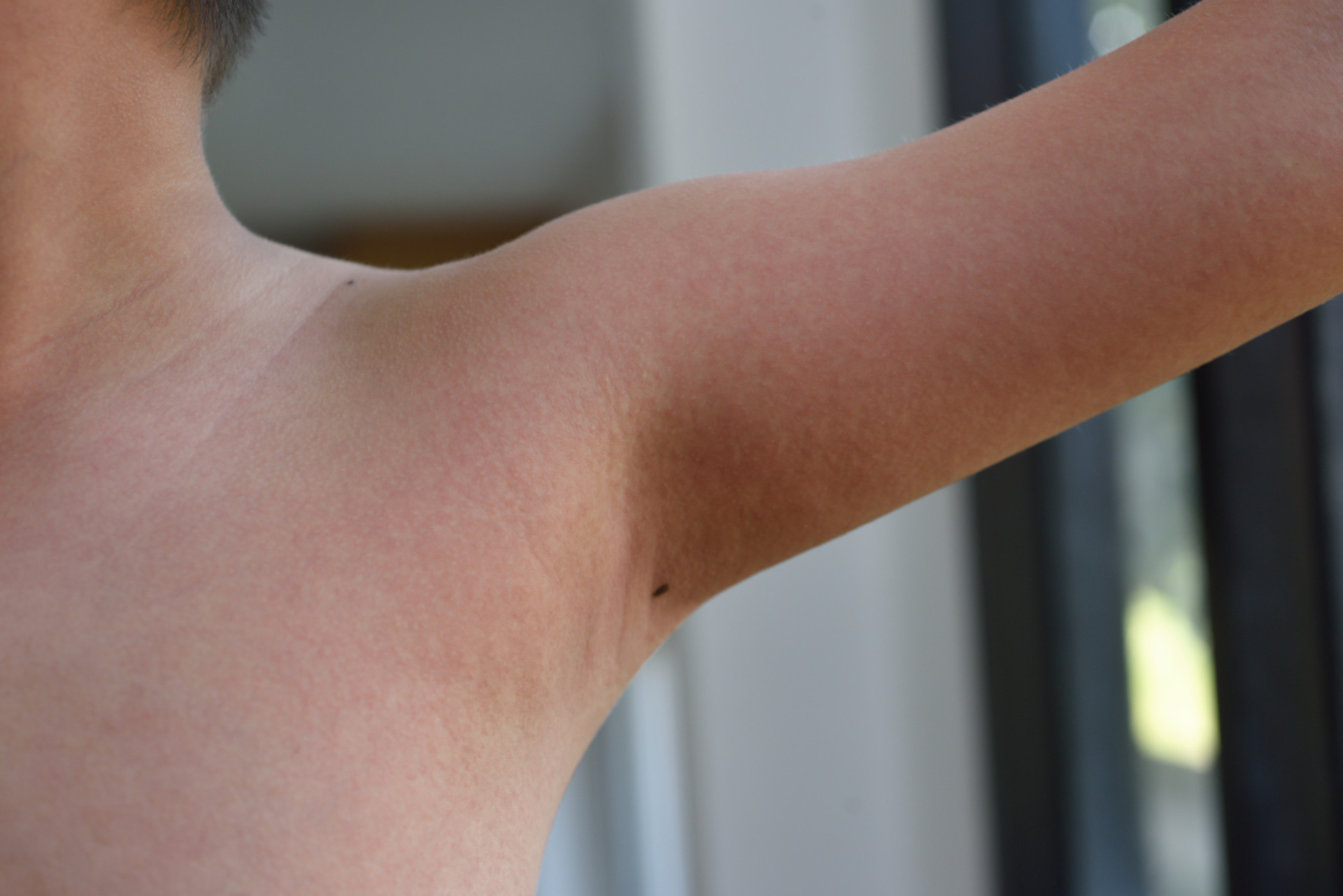 How serious is scarlet fever?