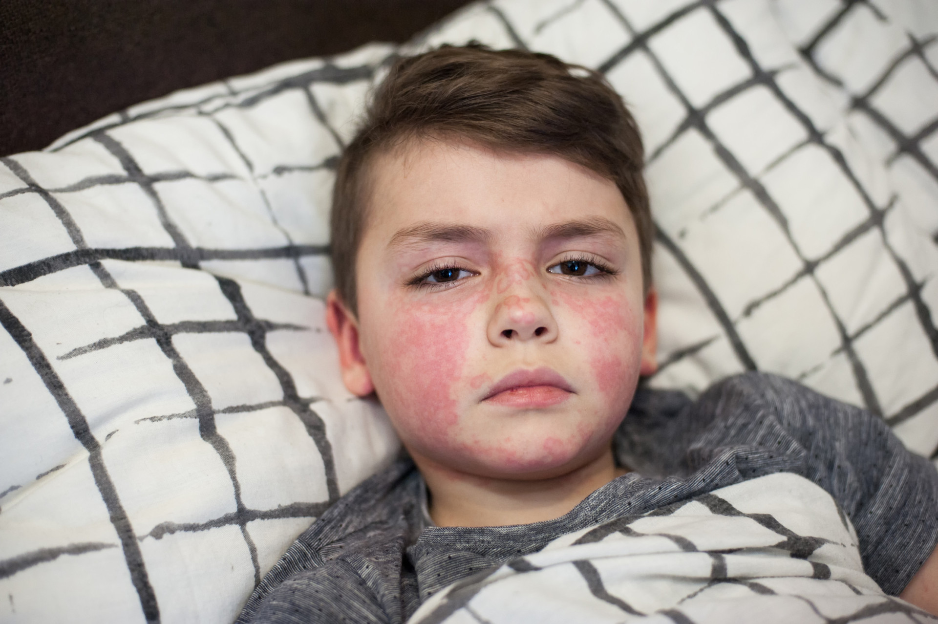 How serious is scarlet fever 