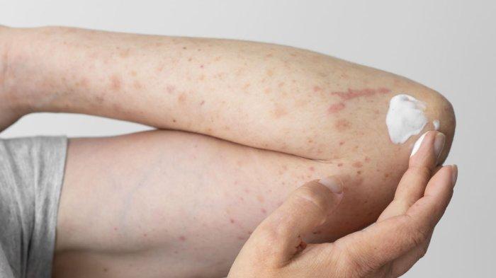 memar muncul tiba-tiba di kulit padahal tidak terbentur,mungkin ini 7 penyebabnya