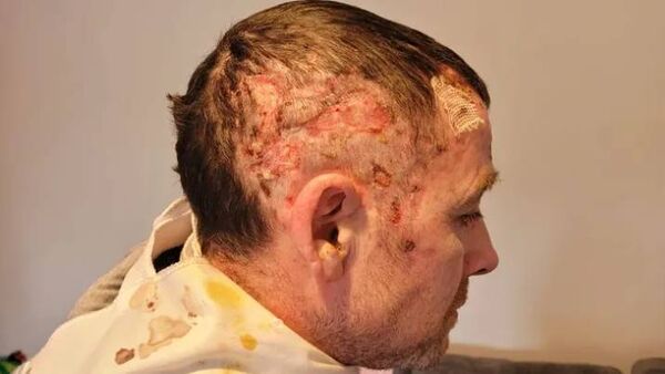 brother launches fundraiser for corkman who lost an eye after corrosive liquid attack