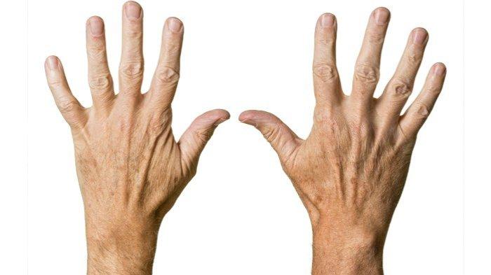 ketahui 5 penyebab tangan keriput di usia muda