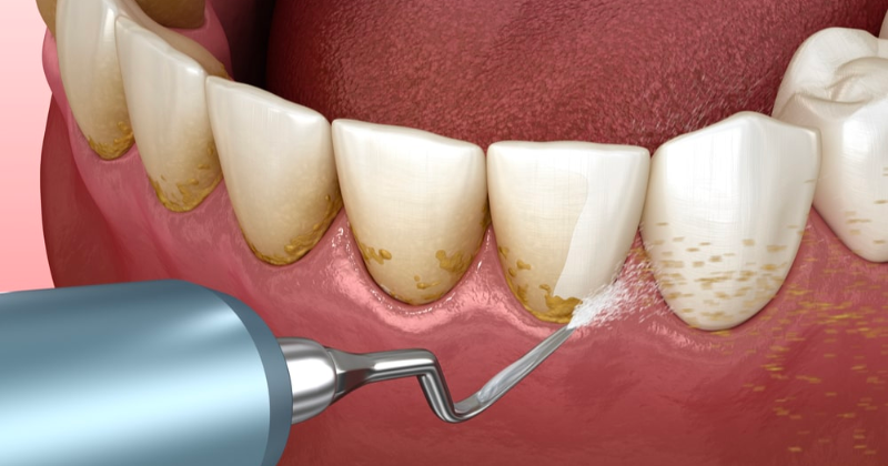 syarat dan cara scaling gigi pakai bpjs kesehatan