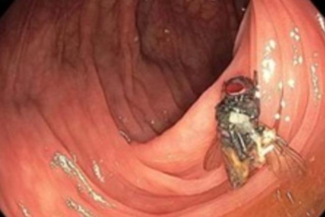 desconcertante resultado: médicos encuentran una mosca viva en el colon de un paciente