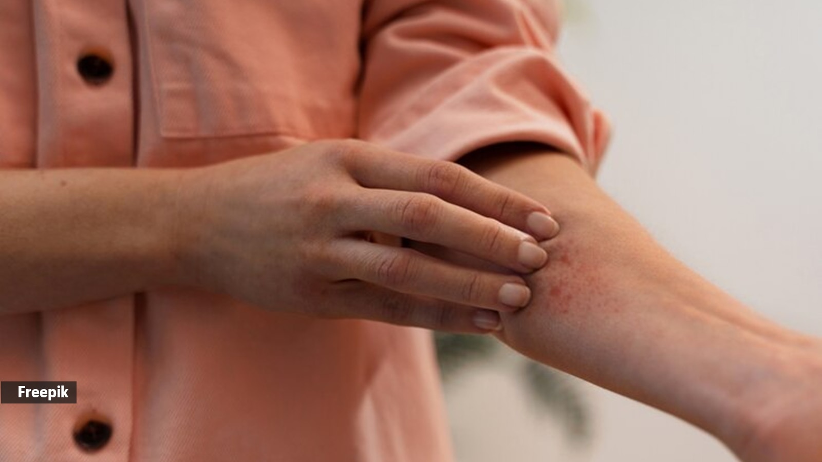 5 most common skin rashes and how to deal with them