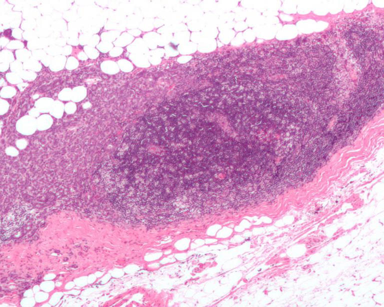 Micrograph showing a lymph node invaded by ductal breast carcinoma, with extension of the tumor beyond the lymph node. Credit: Nephron/Wikipedia