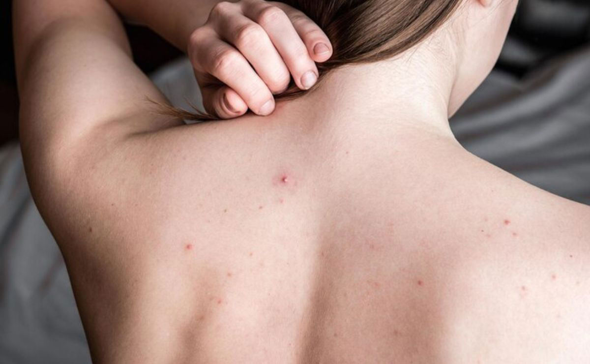 Cómo combatir el acné en la espalda