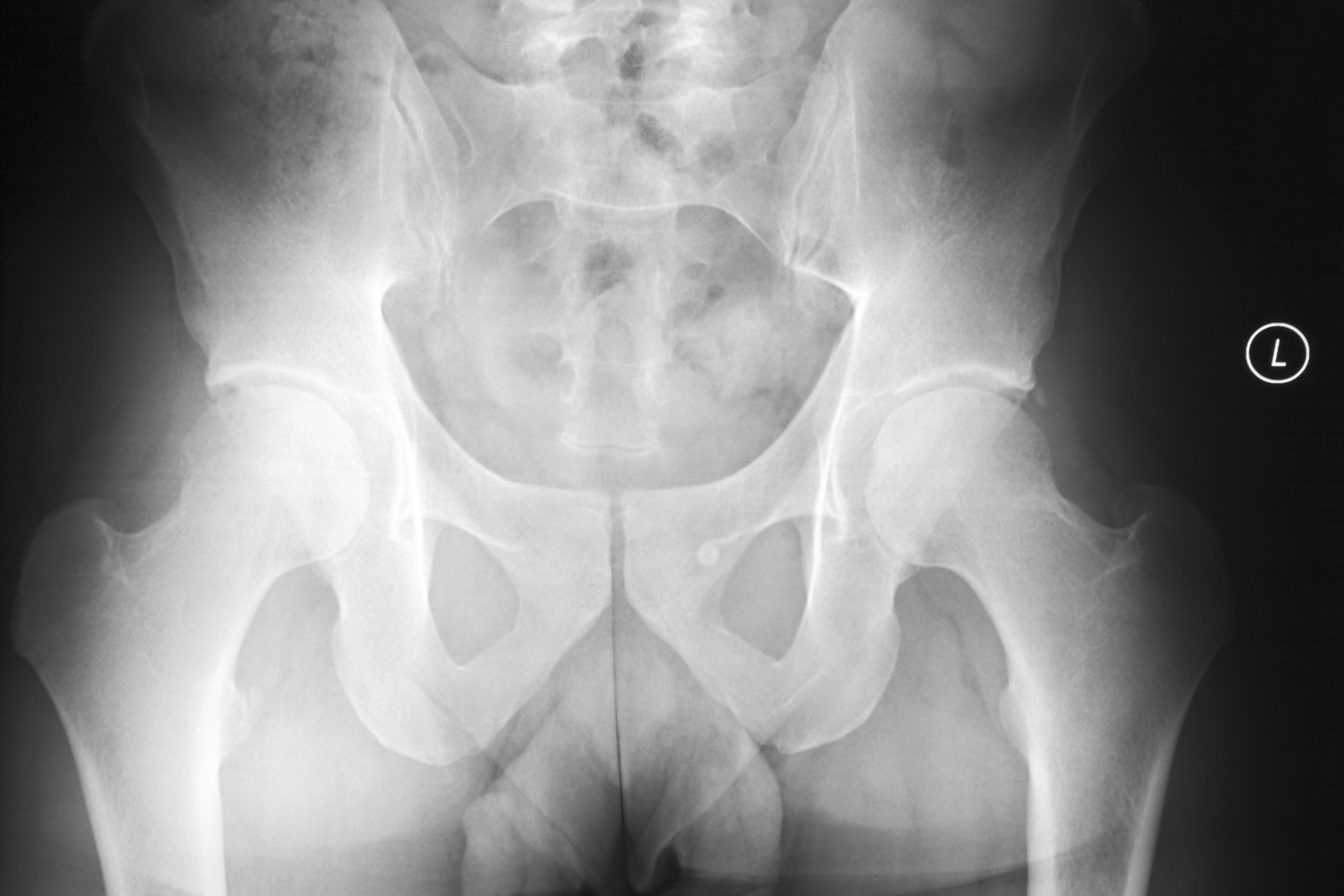 Расширение таза мужчин. Рентген бедренной кости. Кости таза рентген норма. Рентген таза и тазобедренных суставов.