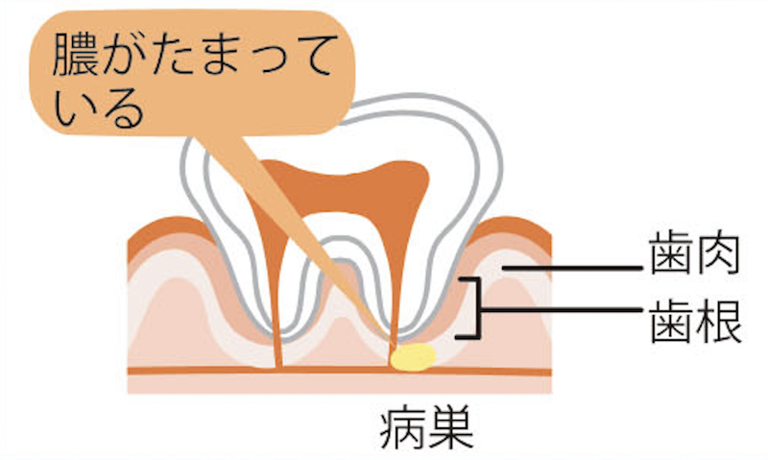 根尖病巣