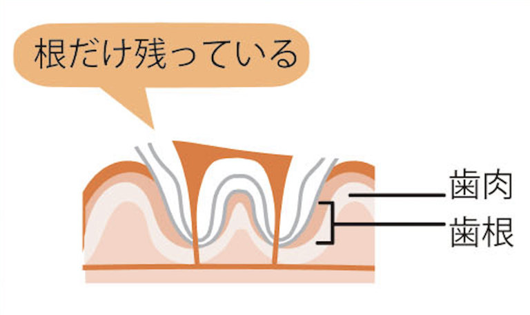 重度の虫歯