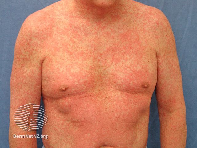 Lamictal Rash From Medication How Symptoms Look   AA1lEgKs.img