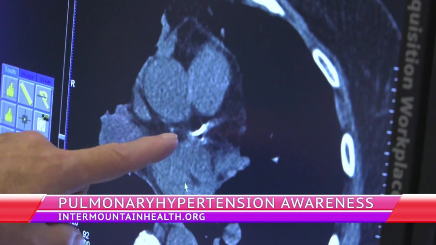 Awareness, prevention, & treatment of pulmonary hypertension – What you ...