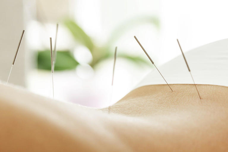 7 Good Reasons to Book an Appointment With an Acupuncture Clinic