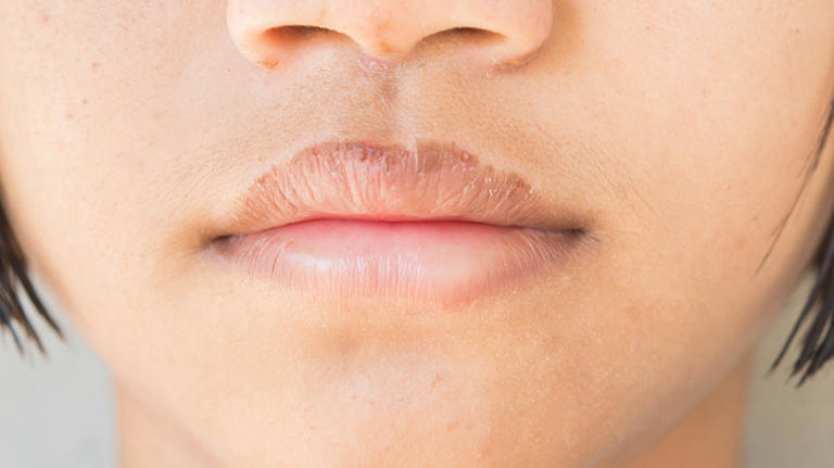 What Causes Lip Discoloration & How Can You Treat It?