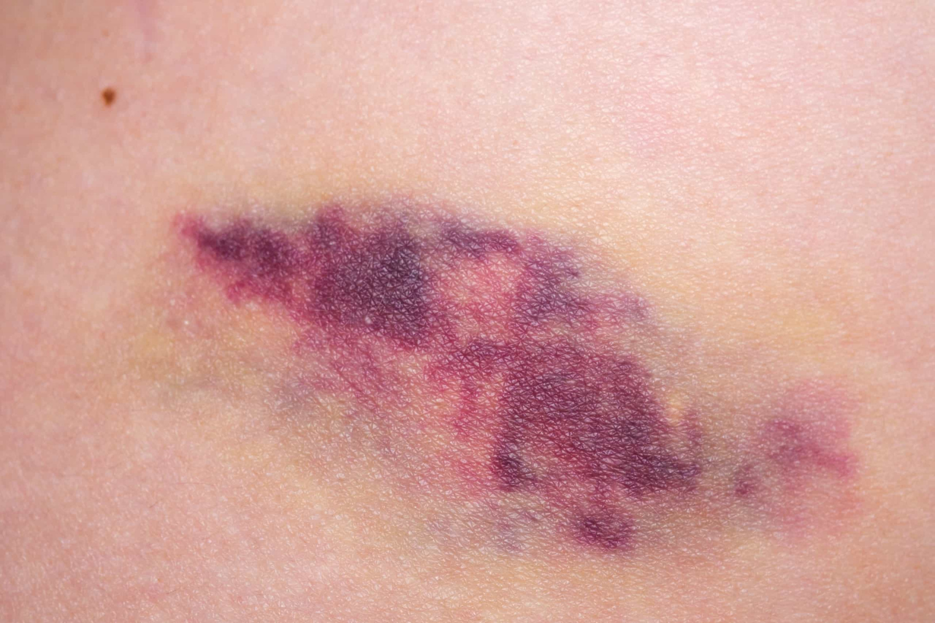 Understanding ITP: A rare autoimmune disorder