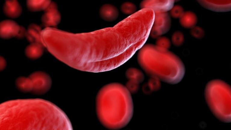 Children living with sickle cell can be treated safely using ...
