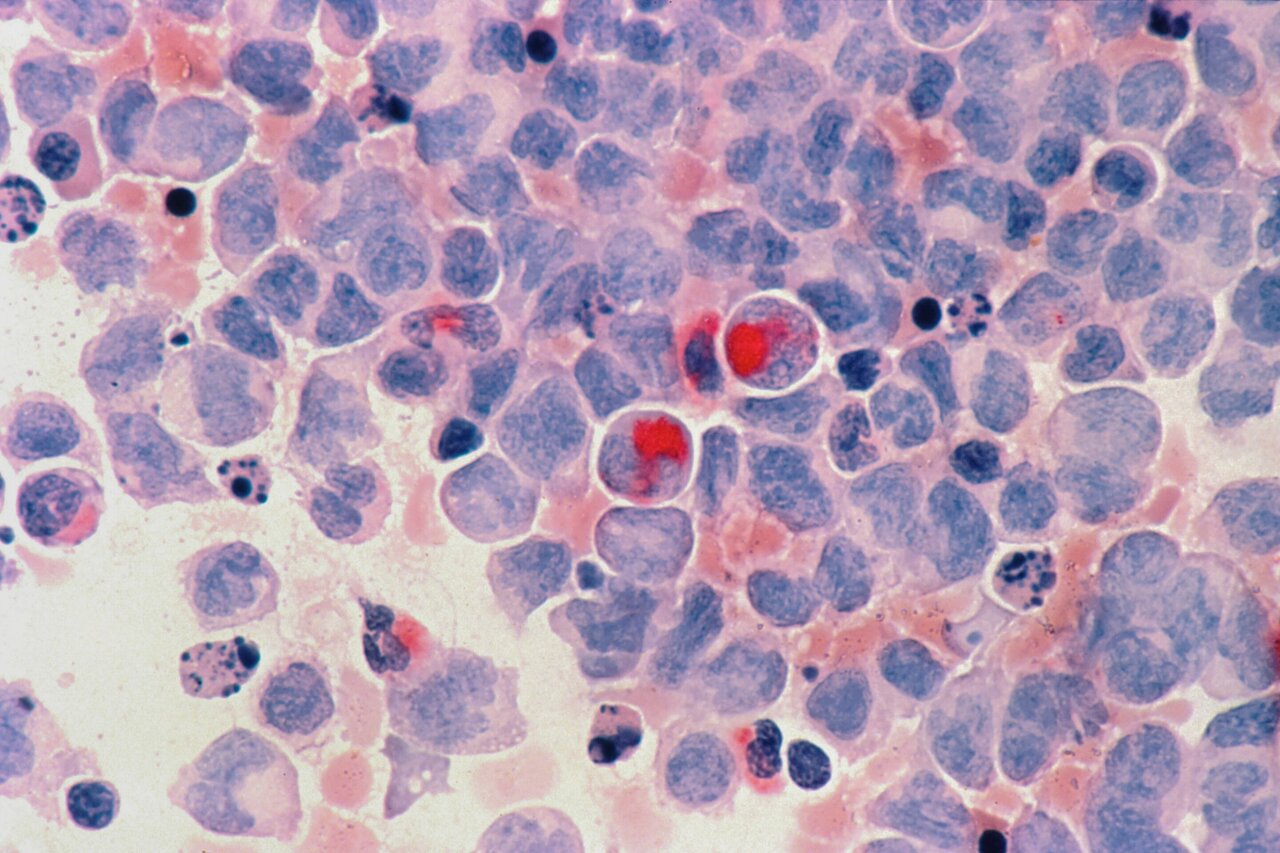 Common leukemia mutation derails protein positioning during cell ...