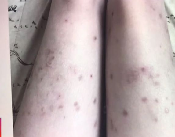 紅斑性狼瘡患者常見紅斑。（示意圖／翻攝自TNAMCOT YouTube）