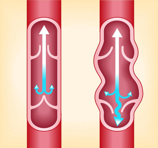 Αριστερά: Πώς λειτουργούν σωστά οι βαλβίδες στις φλέβες για να ανέρχεται το αίμα προς τους πνεύμονες. Δεξιά: οι βαλβίδες έχουν χαλάσει και προκαλούνται κιρσοί (φλεβίτιδα) Bigstock