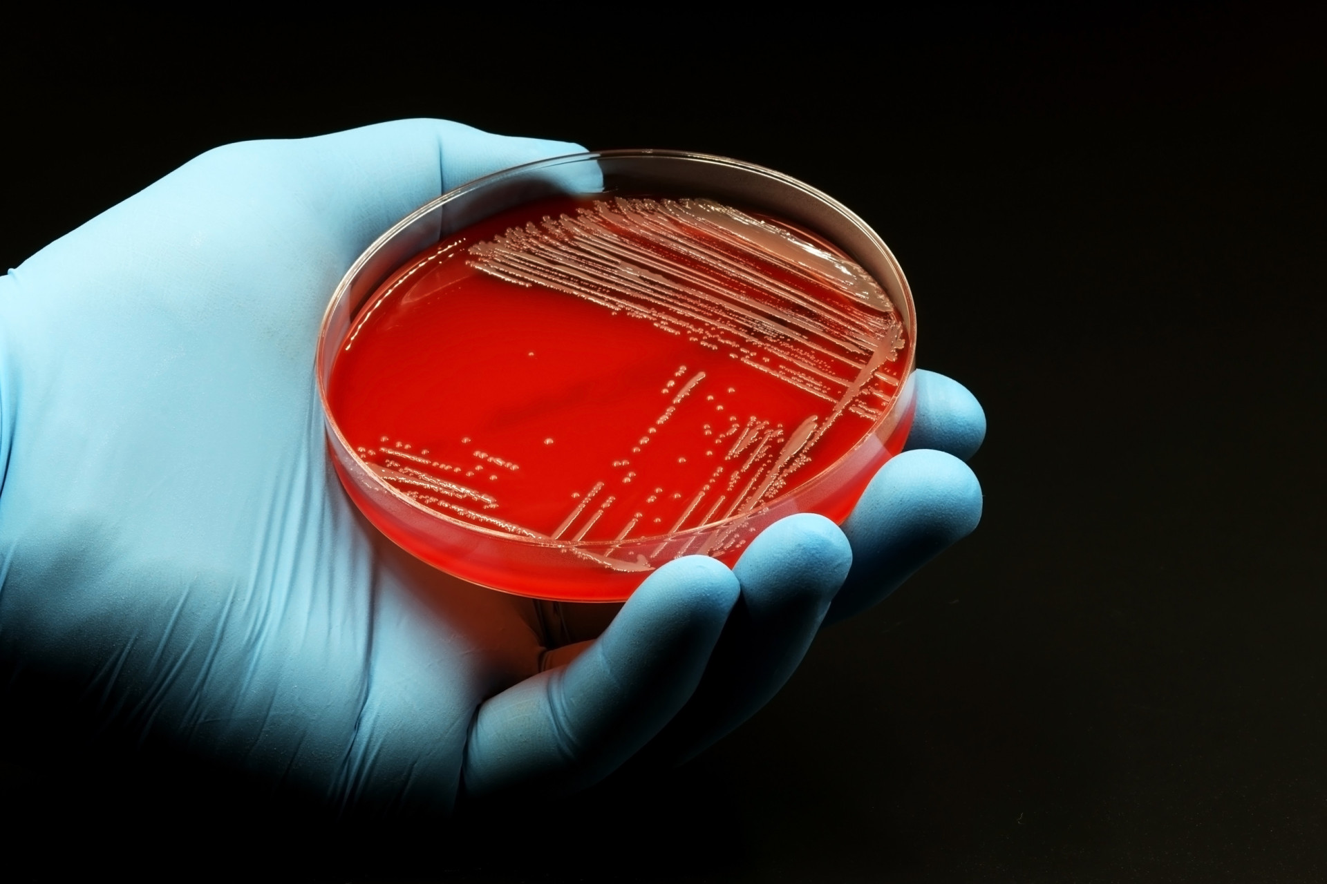 Scarlatine: comment diagnostiquer et traiter cette maladie