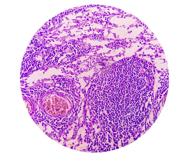 【写真】胃腺がんの顕微鏡像