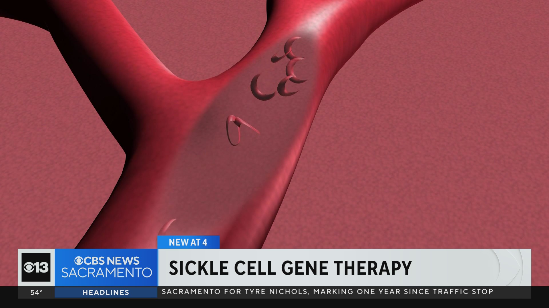 FDA Approves CRISPR Gene-editing Therapy For Sickle Cell Treatment