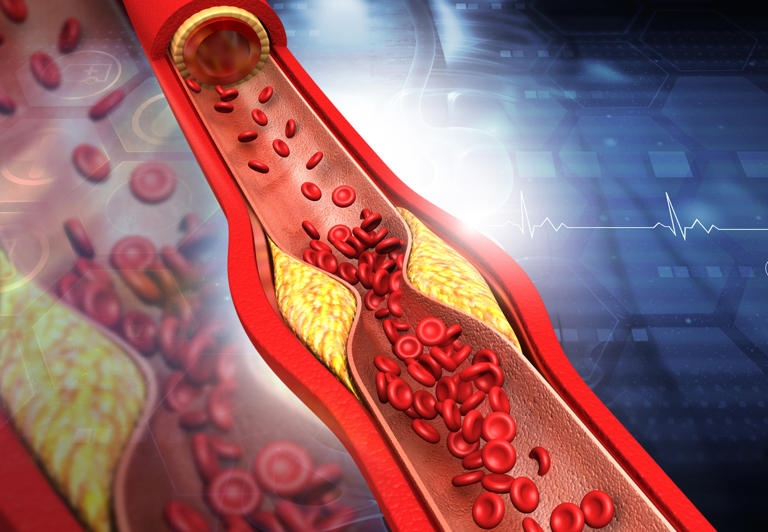 Clogged arteries, Cholesterol plaque in artery. 3d illustration