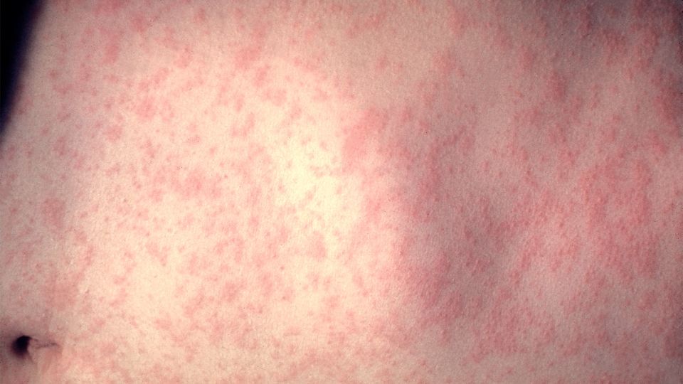 measles outbreak involving cases at a philadelphia day care center expands, health officials say