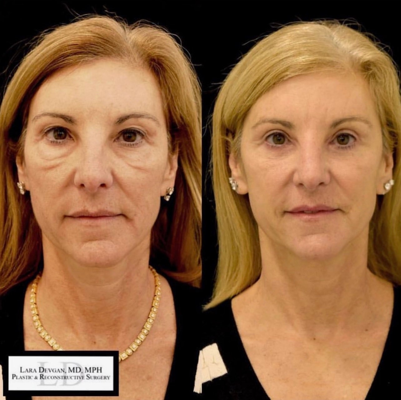 Blepharoplasty The Eyelid Lifting Procedure Is On The Rise But Is It   AA1mIc5o.img