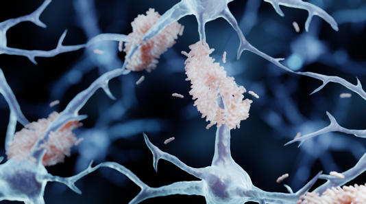 Artist's impression of abnormal protein clumps forming in the brain. These clumps are believed to cause Alzheimer's disease.