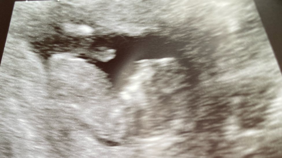 i was sterilised last year - why am i pregnant again?