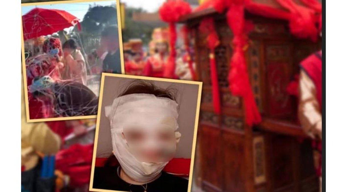 pernikahan berubah tragis wajah pengantin wanita melepuh terbakar gegara ulah para tamu,kini cacat