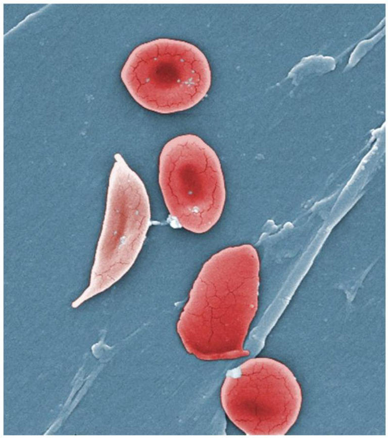 Sickle cell pain may involve previously unrecognized biological pathways