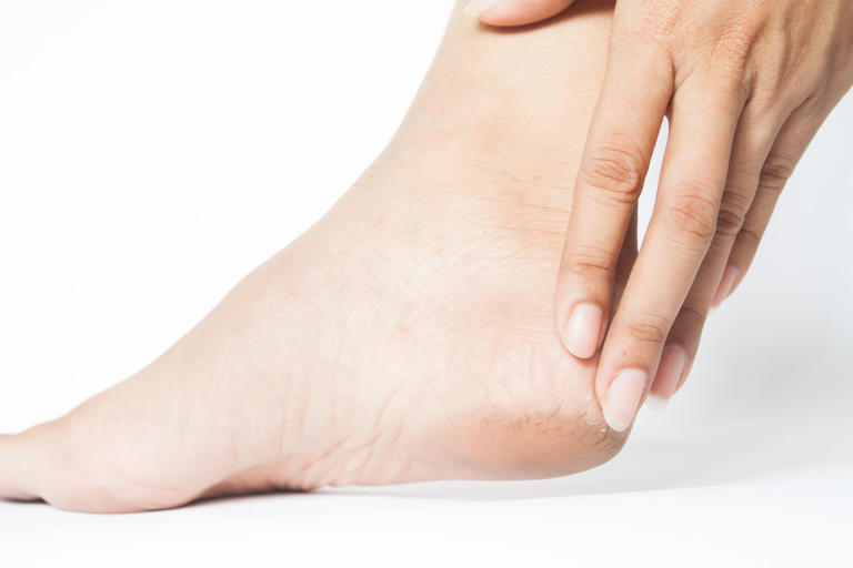 Say Goodbye To Cracked Heels With This Affordable Home Remedy Using 