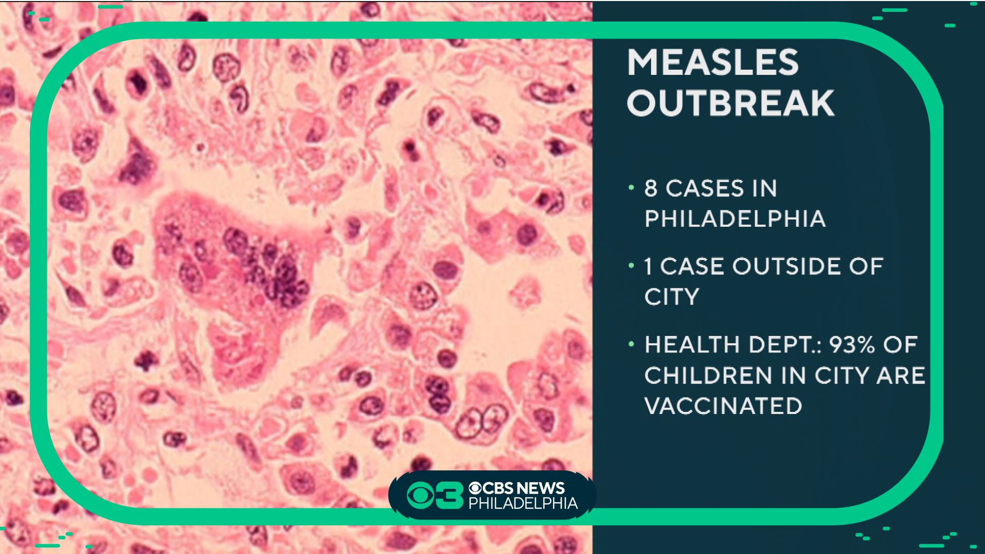 9 Total Measles Cases Reported In And Around Philadelphia, Health ...