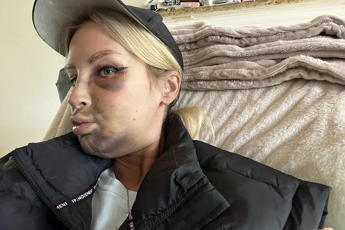 임플란트 수술 4일 만에… 얼굴 전체 ‘보랏빛 피멍’ 든 여성 (+충격 사진)