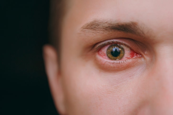 ¡atención! aumentan casos de sífilis ocular que podría causar ceguera irreversible