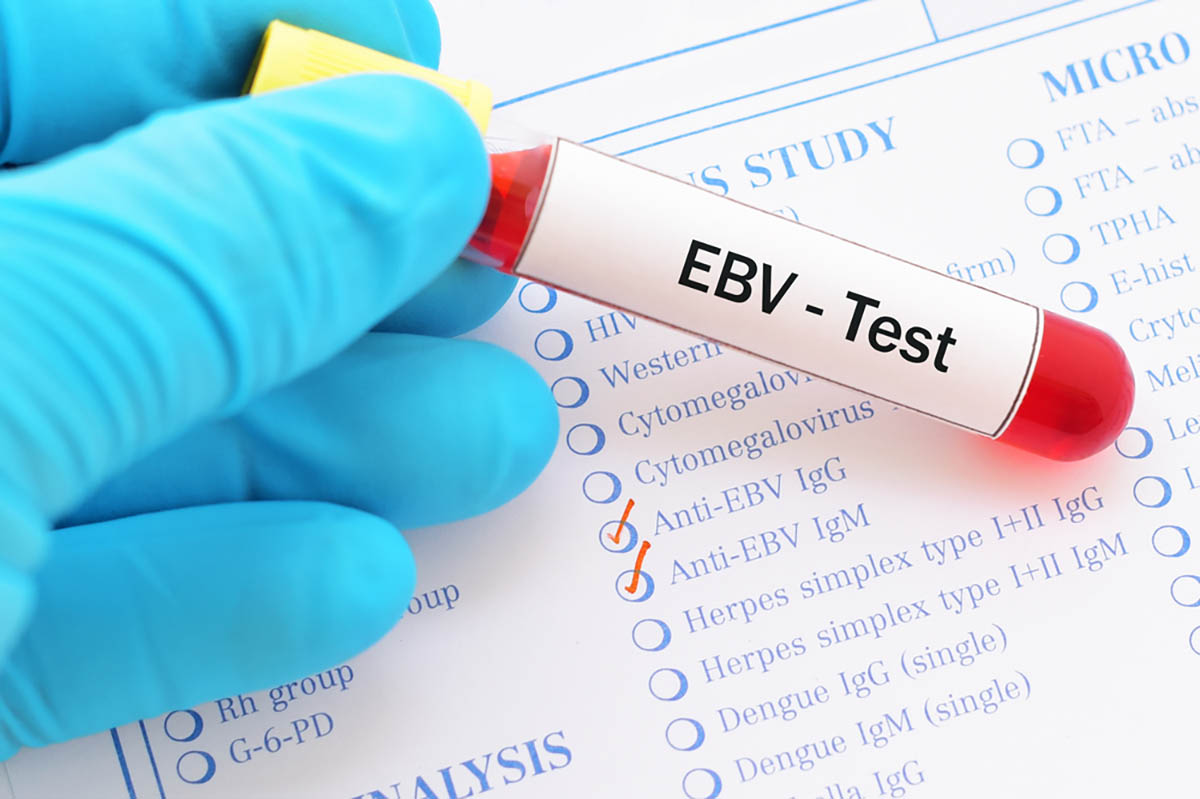 virus de epstein-barr: comprendiendo su papel en las enfermedades crónicas