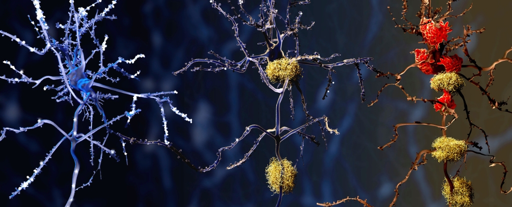 brain autopsies reveal a potential new culprit behind alzheimer's disease