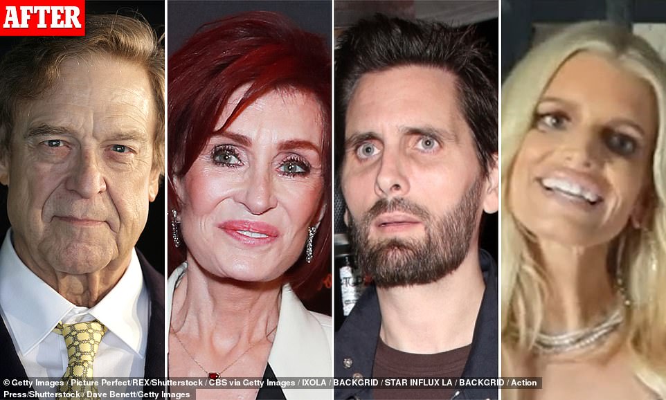 Plastic surgeons reveal the celebs suffering from 'Ozempic face'