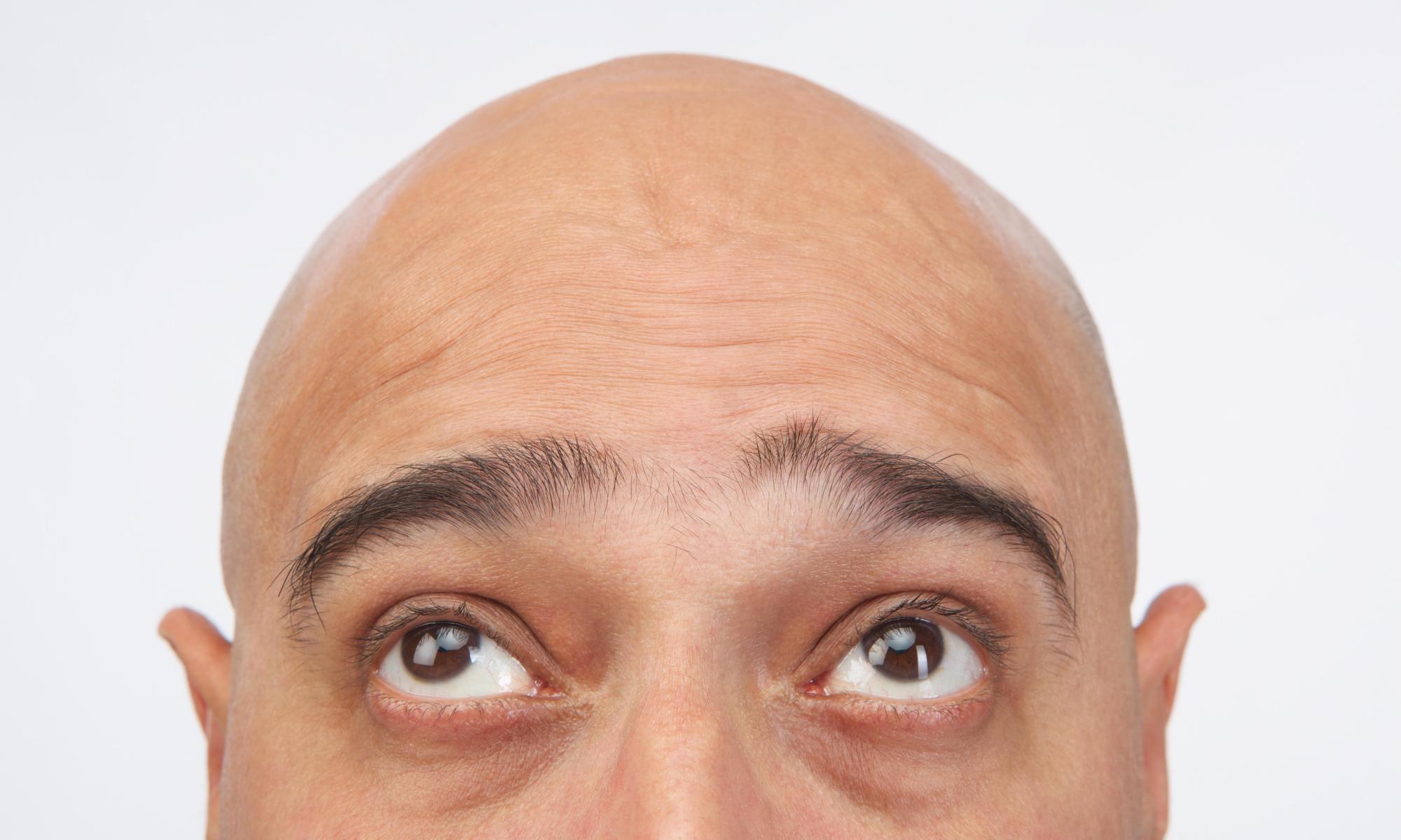 hair yesterday, gone today: why we are happily bald